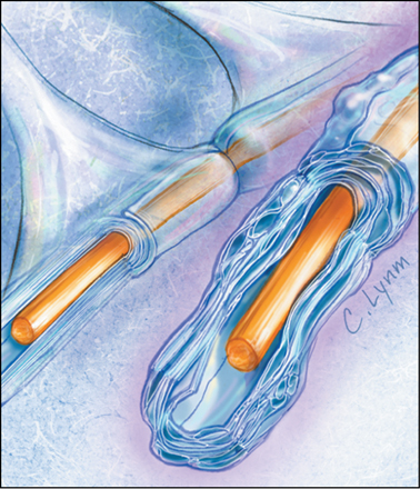 Η χοληστερόλη συντελεί στη θεραπεία της νόσου Pelizaeus-Merzbacher